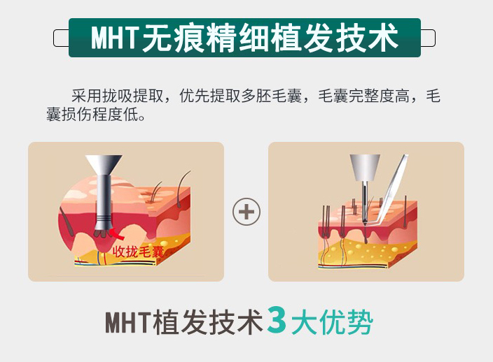 MHT�o(w��)�۾���(x��)ֲ�l(f��)���g(sh��)